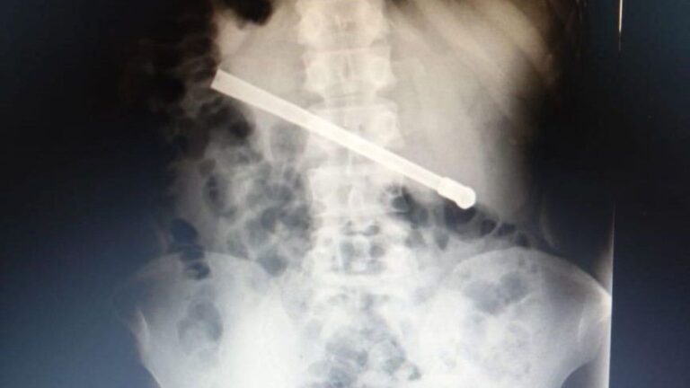 Un preso en Rosario se tragó una bombilla y tuvieron que operarlo de urgencia